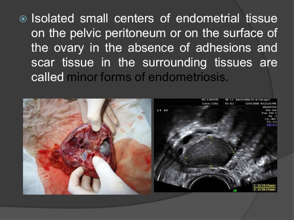 Isolated small centers of endometrial tissue on the pelvic peritoneum or on the surface